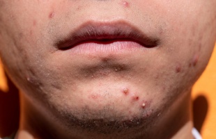 Kamaszkori bőrhibák, bőrpanaszok mérséklése,  elfedése  természetes hatóanyagú kozmetikumokkal