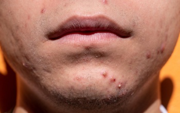 Kamaszkori bőrhibák, bőrpanaszok mérséklése,  elfedése  természetes hatóanyagú kozmetikumokkal