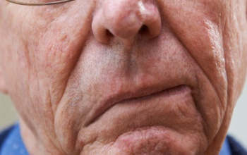 Ma van a stroke világnapja – életet menthet a gyors felismerés